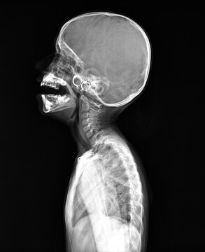 Clear occipitomental projection of a human head captured via digital radiography for evaluating the nasal area and midfacial bones.