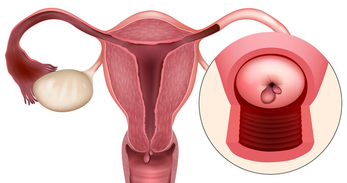 Uterine Cervix Polyp Detailed Gynecological Diagram with Zoomed View. Female Reproductive System with Cervical Polyp Close Up Medical Infographic
