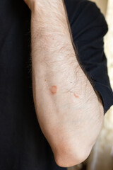 Naklejka premium Skin lesions on male arm close up, dermatology problem