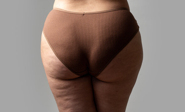 Cellulite on thigh with subcutaneous fat and circulation. Anti cellulite cream for thigh and skin. Natural body with cellulite on thigh and legs. Dermatology procedure for cellulite on thigh.