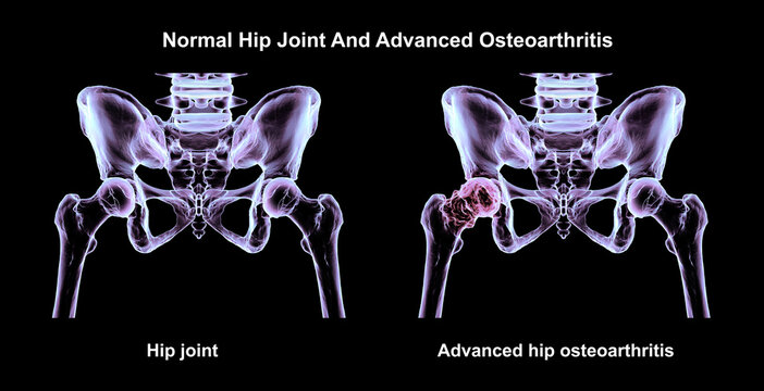 Normal hip joint and advanced hip osteoarthritis, 3D illustration