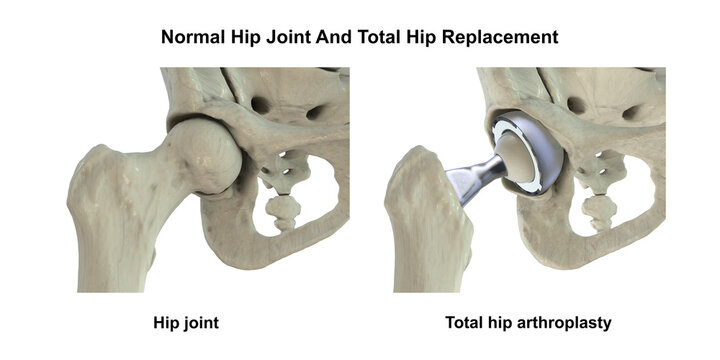 Normal healthy hip joint with intact femoral head, acetabulum, articular cartilage and joint space, and total hip replacement, 3D illustration.