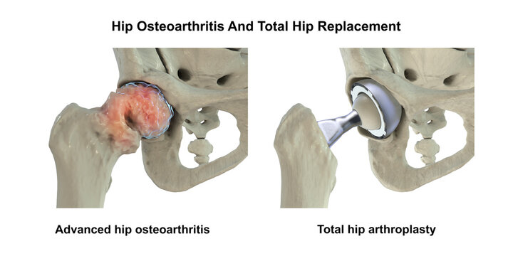 Advanced hip osteoarthritis with joint space narrowing, osteophytes and cartilage loss, and total hip replacement prosthesis, 3D illustration.