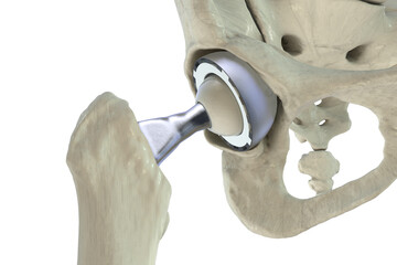 Total hip replacement prosthesis. Shows femoral stem with head, acetabular cup with liner, and...