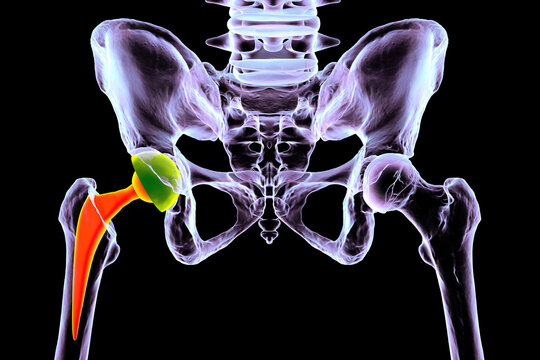 Total hip replacement prosthesis. Shows femoral stem with head, acetabular cup with liner, and articulation in the hip joint. 3D illustration.