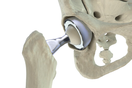 Total hip replacement prosthesis. Shows femoral stem with head, acetabular cup with liner, and articulation in the hip joint. 3D illustration.