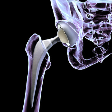 Total hip replacement prosthesis. Shows femoral stem with head, acetabular cup with liner, and articulation in the hip joint. 3D illustration.
