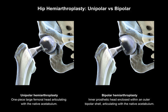 Two types of hip hemiarthroplasty: unipolar versus bipolar prosthesis. 3D illustration.