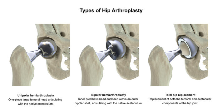 Three types of hip prostheses: unipolar hemiarthroplasty, bipolar hemiarthroplasty and total hip replacement, 3D illustration