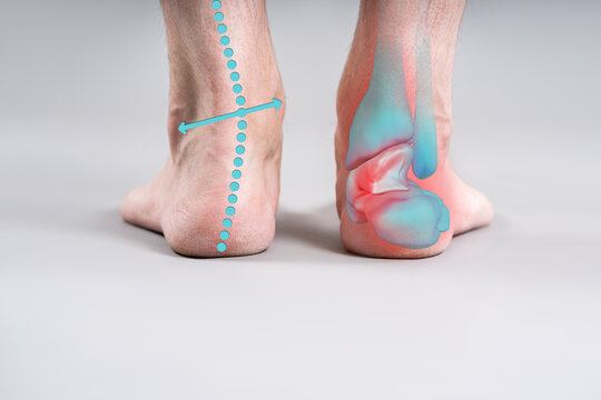 Orthopedic concept of ankle pain and foot biomechanics, joint inflammation and alignment lines