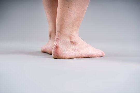 Female foot with blister, callus and dry skin on the heel. Shoe bite, foot pain and podiatry