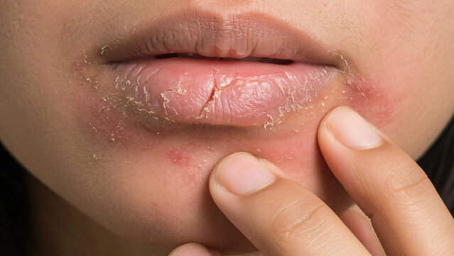 Closeup of dry chapped lips with peeling skin being touched by finger