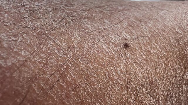 Macro shot of dry skin (ichthyosis) detail