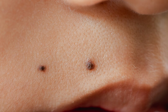 A macro close-up of human facial skin showing two moles near the lips, highlighting natural skin texture and dermatology details.
