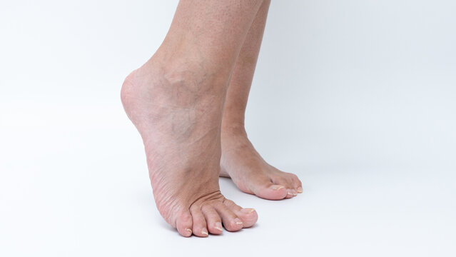 Varicose veins visible on female legs, showcasing skin texture and anatomical details, highlighting health concerns and aesthetic issues in a clinical context
