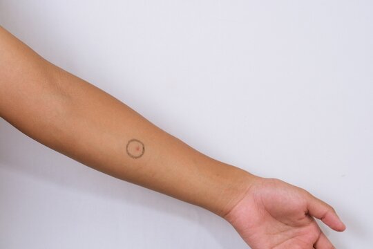 Close up of Mantoux test mark on human skin showing medical screening for tuberculosis with visible injection reaction on forearm.