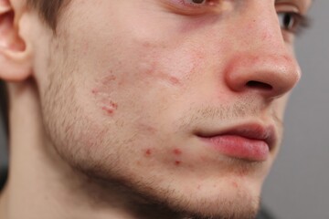 Obraz premium Young man experiencing skin problems with acne, pimples, and scarring on his face, showing skin imperfection