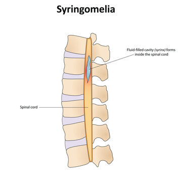 Syringomyelia vector illustration