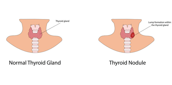 Thyroid nodules vector illustration