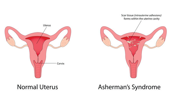 Asherman's syndrome vector illustration