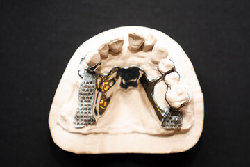 Naklejka premium 3D printed dental model and metal support parts.
