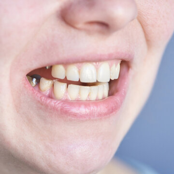 Close Up Of Person Open Mouth Showing Missing Tooth Gap And Metal Dental Fillings During Dental Examination In Clinical Setting With Gloved Hand And Blue Background.