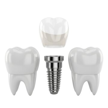 Dental implant components including crown, abutment, and implant post