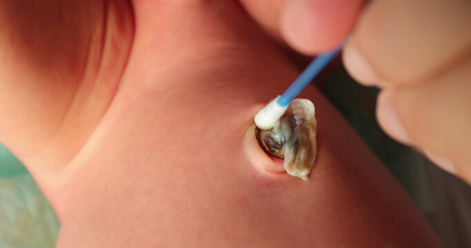 Cleaning newborn baby umbilical cord, first week of life