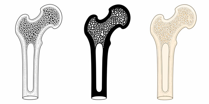 Three detailed illustrations of a human femur bone in gray, black, and beige colors side by side