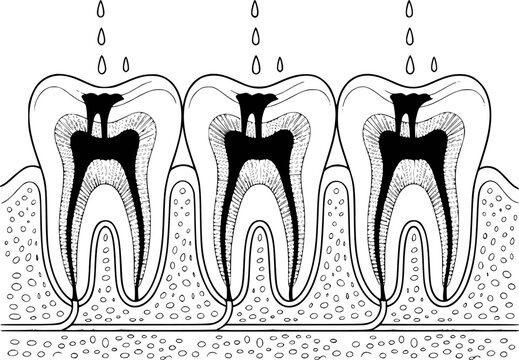 Dental cross-section showing tooth decay and root canal treatment process