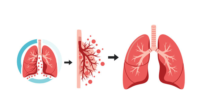 Three-step medical diagram demonstrating the process of lung inflammation, mucus buildup, and respiratory infection within the airways.