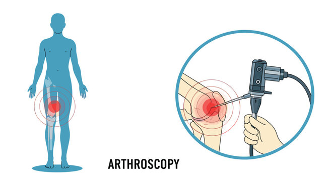 Medical illustration showing the process of knee arthroscopy with an arthroscope instrument inserted into the joint for surgery or diagnosis.