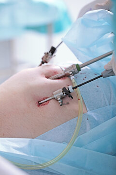 Modern laparoscopic surgery. Laparoscopy in surgery. Surgical intervention through small holes. Team of surgeons. Laparoscopic instruments