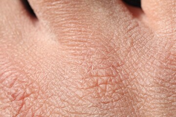 Fototapeta premium Man with dry skin on his hand, closeup