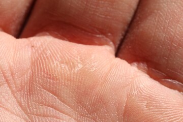 Fototapeta premium Man with dry skin on his hand, closeup
