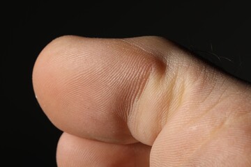 Naklejka premium Man with dry skin on his foot against black background, closeup