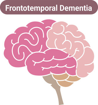 Frontotemporal dementia brain illustration flat