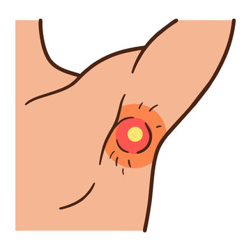 Illustration of a Skin Abscess or Inflamed Boil in the Armpit Area