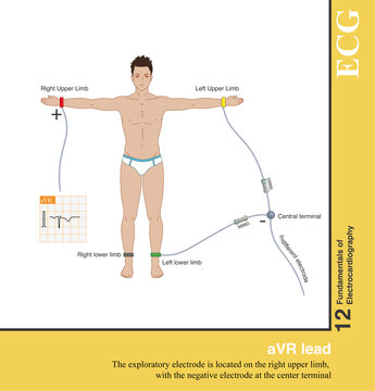 The positive electrode of the aVR lead is the right upper limb electrode, and the negative electrode is the Goldberger central terminal, which explores the electrical activity of the heart in the uppe