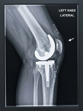 A lateral X-ray image displays a left knee with a total knee replacement. The image shows the femur, tibia, and patella, all replaced with metallic implants.