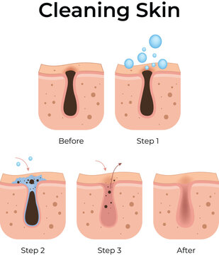 Skin Pore Cleaning Process Design Vector Illustration