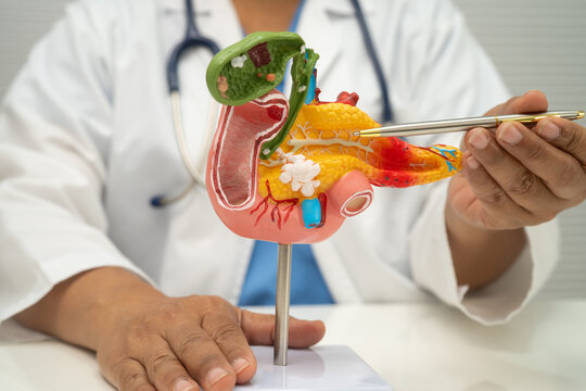 Pancreatitis, pancreatic cancer, Asian doctor with pancreas, gallbladder and bile duct human anatomy model at hospital.