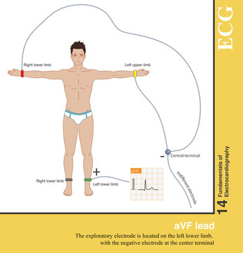 The positive electrode of the aVF lead is the left lower limb electrode, and the negative electrode is the Goldberger central electrode, which explores the electrical activity of the heart in the lowe