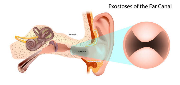 Exostoses of the Ear Canal with Auditory Canal Narrowing Medical Illustration. External auditory exostosis (EAE) Surfer's ear. Ear Canal Exostoses Bone Growths Leading to Canal Constriction