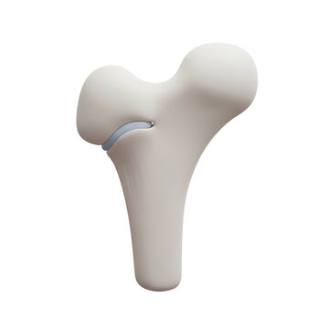 Rendered anatomical illustration of a femur bone against a black background