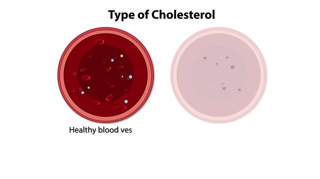 Dynamic animation of cholesterol types showing healthy blood vessel versus atherosclerosis condition with good and bad cholesterol.