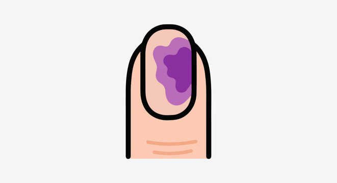 Close-up illustration of a bruised fingernail with purple discoloration