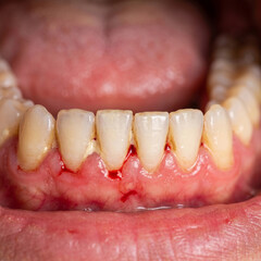 Obraz premium Extreme close-up of human teeth with red bleeding gums, conceptual image of gingivitis, periodontitis and oral hygiene inflammation problems