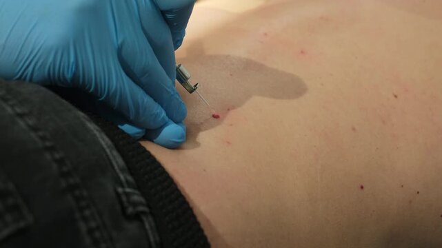 Dermatologist removes hemangioma with laser coagulation probe in clinic slow motion. Safe painless procedure of birthmarks treatment in medical center