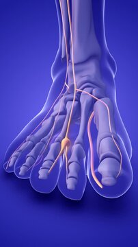A Morton's neuroma on a foot nerve